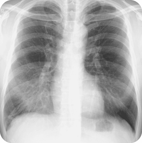 Chest X-ray original